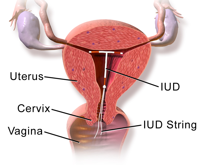 Método DIU - Dispositivo Intrauterino