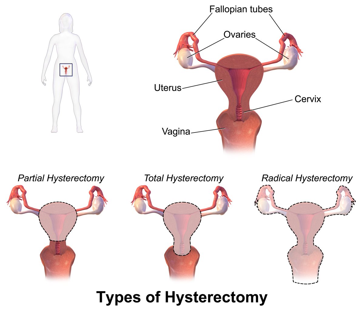 Histerectomía abdominal